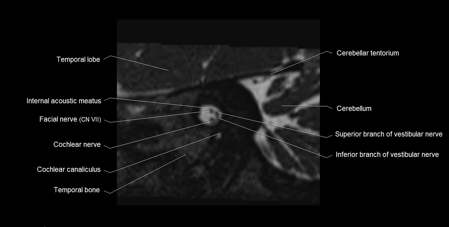 Internal auditory meatus (IAM) 3T sagittal cross sectional anatomy image 18.webp